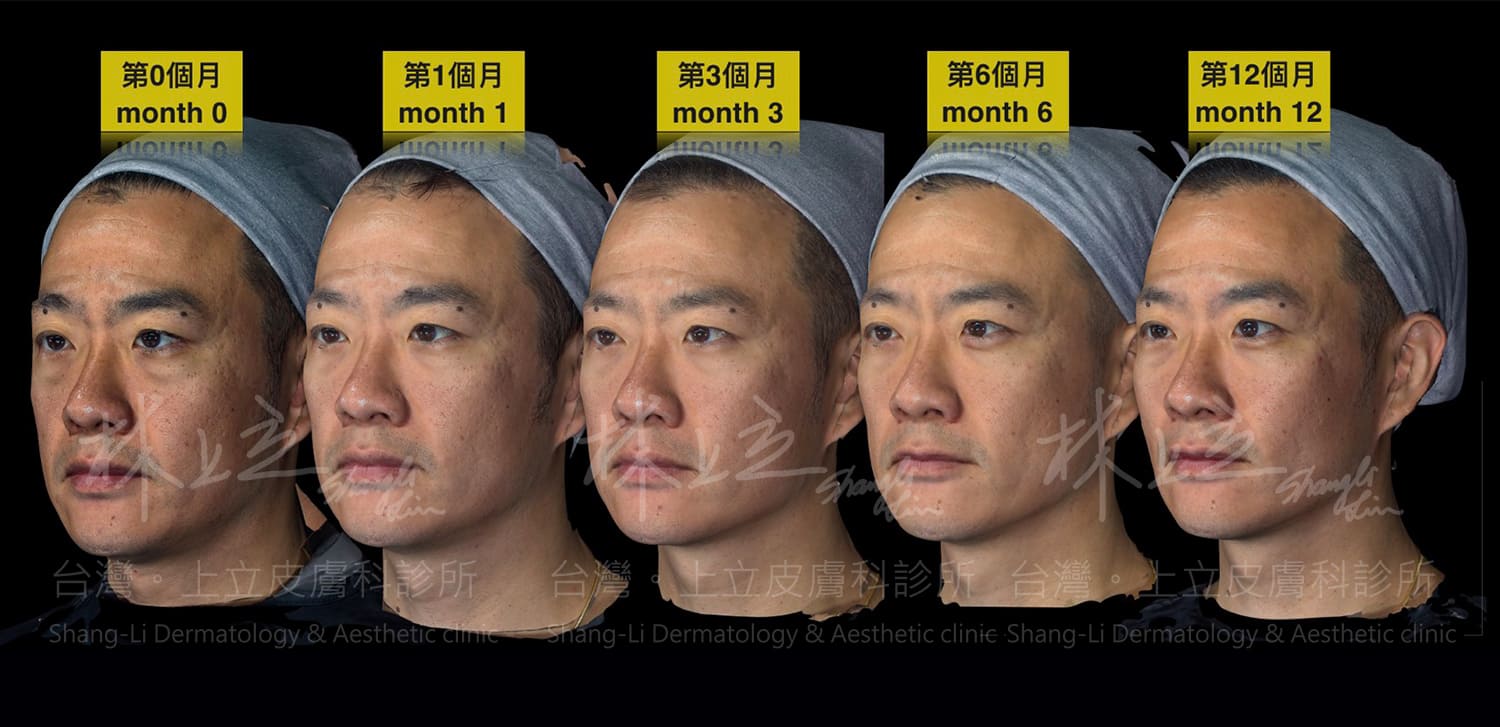 利用洢蓮絲重建臉部體積支撐之後，淚溝和臉部輪廓獲得明顯改善