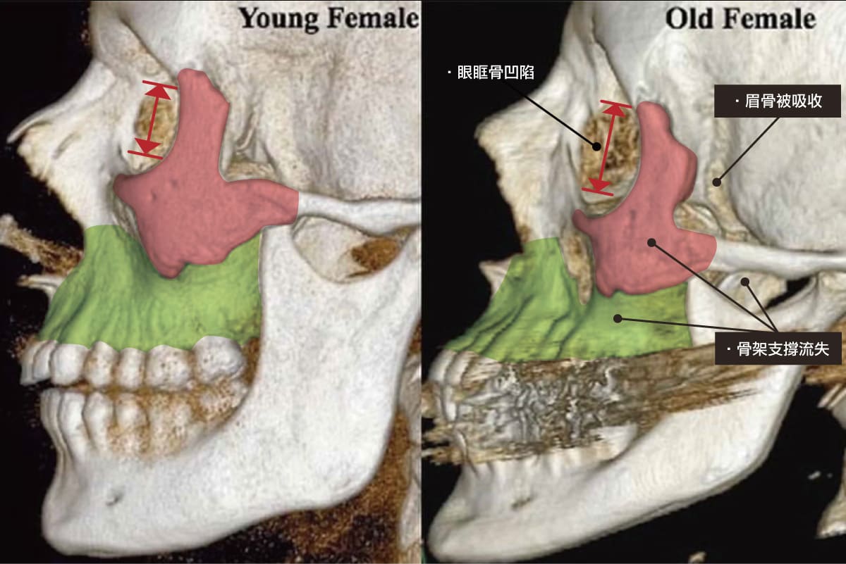 年輕和老化的臉骨骼流失比較