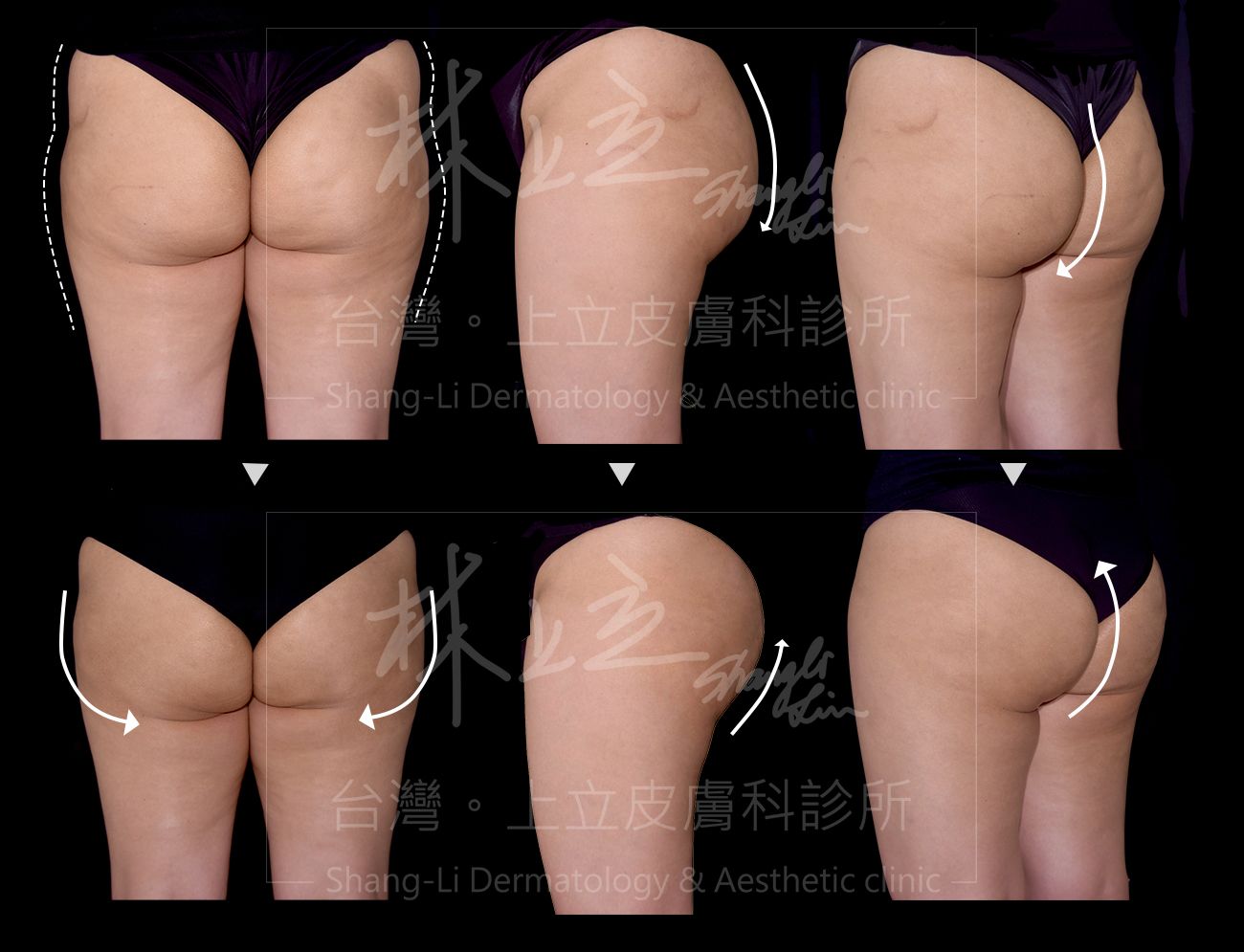SculpSure 絲酷秀也能給予臀部的大面積明顯的減脂治療