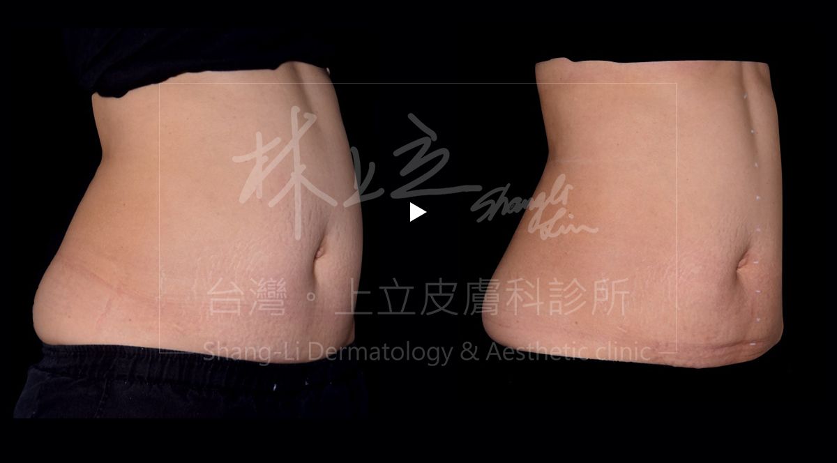SculpSure 絲酷秀在大範圍減少腹部皮下脂肪的同時，產後妊娠紋的痕跡也相對變淺、腹部膚質更細緻，並且凸顯出腰部曲線