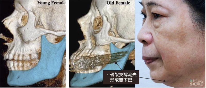 上頷骨的流失會造成脂肪位於上面的軟組織失去了支撐堆積至雙下巴