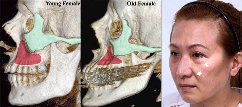 老化會造成骨架體積減少，臉部鬆弛下垂，形成所謂的法令紋。