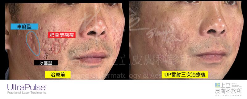 UP雷射三次治療後，可看見痘疤明顯改善，肌膚變得更加平整。