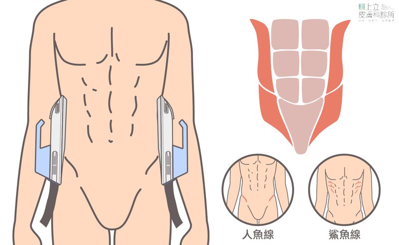 EMSCULPT可刺激腹內斜肌與腹外斜肌，打造人魚線，減少腰間肉。