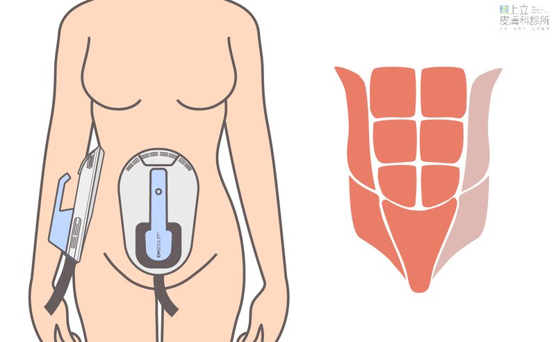 EMSCULPT可透過客製化探頭擺法，即使腹部較小的民眾也可以同時施作兩個探頭，強化腹部肌群，增加效率。