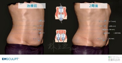EMSCULPT肌動減脂療程兩周後，腰圍減少，看起來較結實。