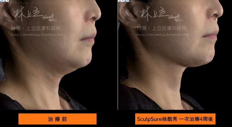 SculpSure絲酷秀案例的治療之後，追蹤一次治療後4周的實際效果，可見雙下巴狀況已改善很多