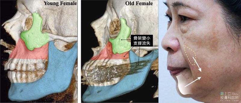 年輕和年老的骨架變化，就可以明顯看見差異。臉部皮膚則會因為失去底層的支撐變得鬆弛下垂，下顎線條模糊不清。