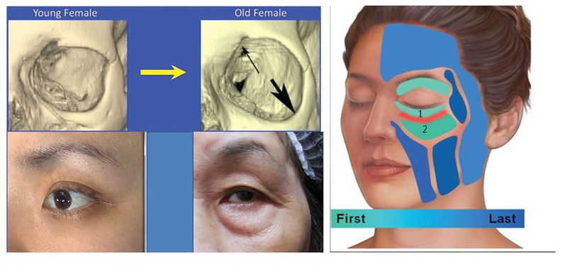 眼周的脂肪是臉部最先流失的，所以淚溝臉上最早出現的皺紋。