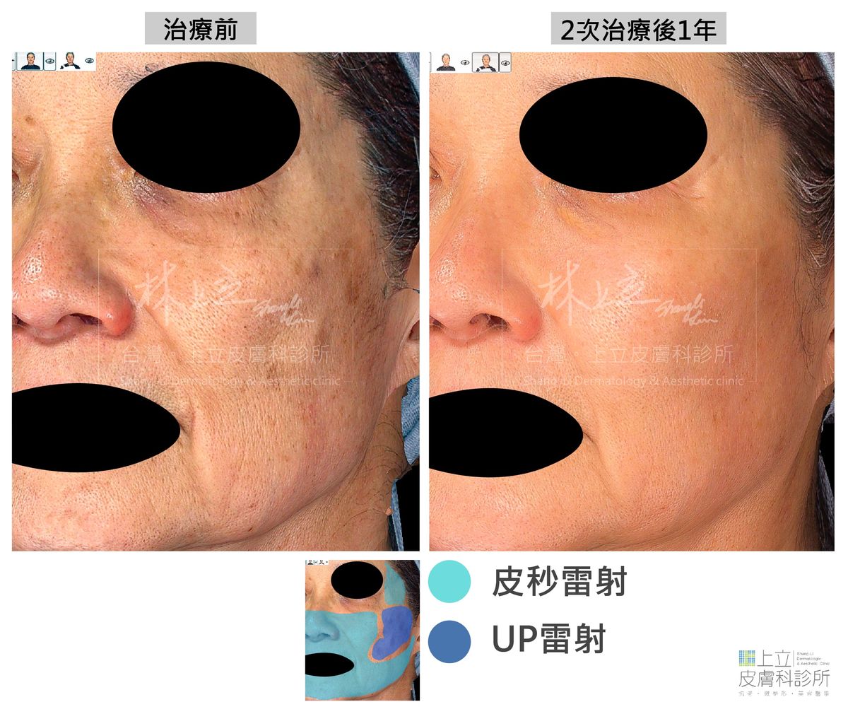 PicoSure皮秒雷射和UP雷射分別運用在臉部不同區塊的治療縮小毛孔