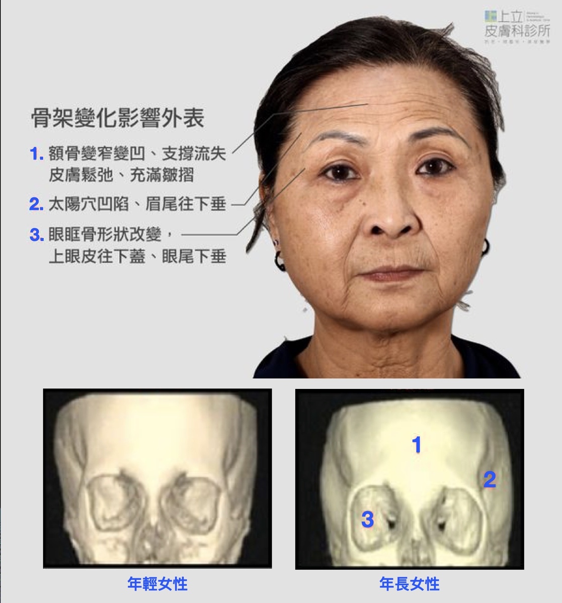 臉部骨架會因為老化流失出現形狀上的改變，夫妻宮不夠立體