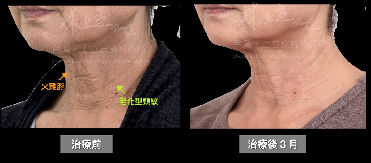 不只有又鬆又垂的老化型頸紋，還有輕微的火雞脖（垂直頸紋），這些頸部皮膚嚴重老化的現象。