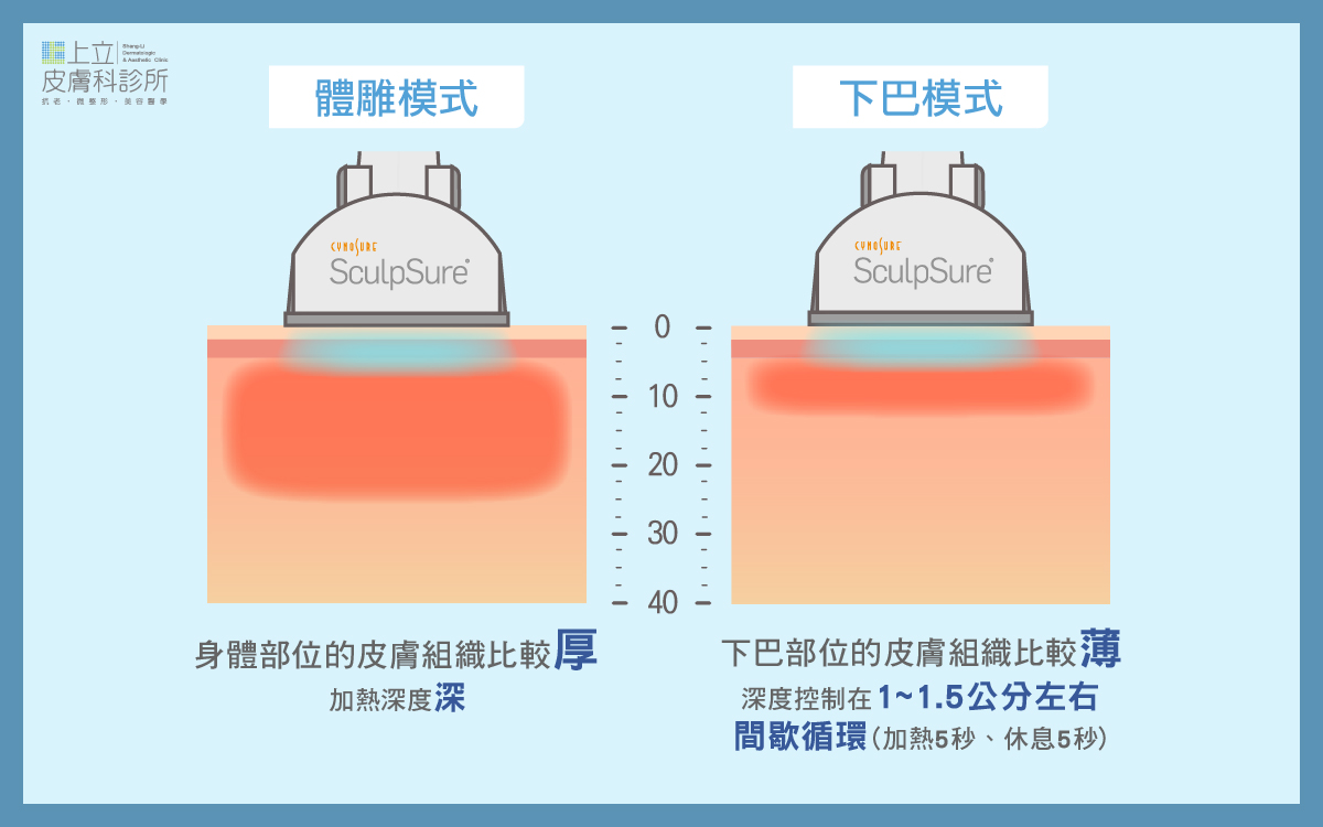 SculpSure熱塑溶脂所推出的「下巴專用探頭」不只減少了能量深度（約1~1.5cm）並採取「間歇循環加熱」模式，有效減少不必要的組織破壞