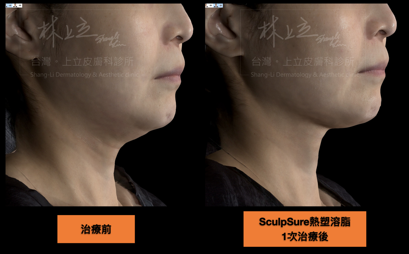 SculpSure熱塑溶脂用於消除雙下巴有很好的效果