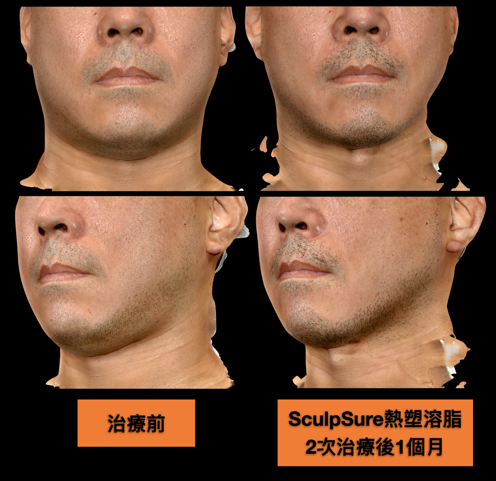 接受2~3次的SculpSure熱塑溶脂，不只從側面觀察雙下巴減脂效果明顯、輪廓線恢復俐落，正面看起來臉型也變瘦、變Ｖ