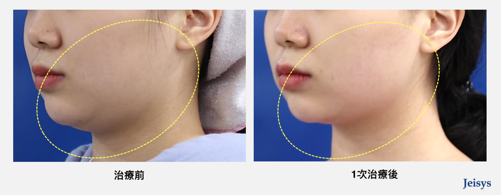 Q+立線音波不只能緊實膚質，也有減脂作用，用於治療雙下巴和嘴邊肉具有很好的改善效果，可見在單次治療後，原先肥厚的雙下巴獲得很大的進步