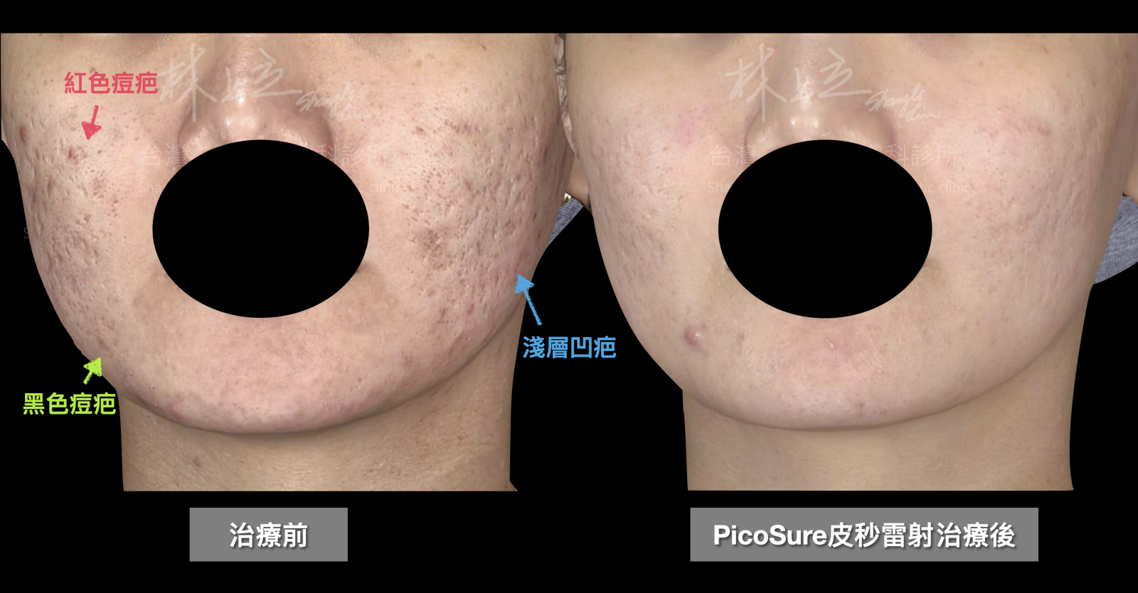存在黑色痘疤、紅色痘疤和淺層凹疤的狀況，都在接受PicoSure755蜂巢皮秒雷射的治療之後，得到相當大幅度的改善。