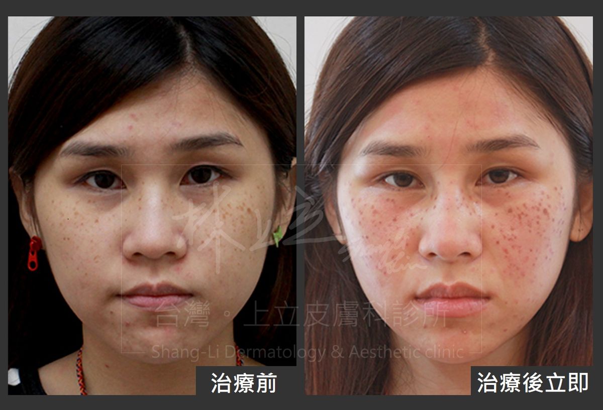 兩頰佈滿雀斑，還有膚色暗沈、毛孔粗大等問題。再利用PicoSure755蜂巢皮秒雷射進行一次治療之後，不只是消除了雀斑，整張臉的膚色也變得比較均勻、透亮許多，改善效果相當顯著。