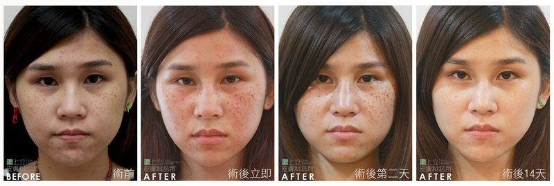 使用PICOSURE pro鉑金蜂巢皮秒雷射來治療臉上的斑點