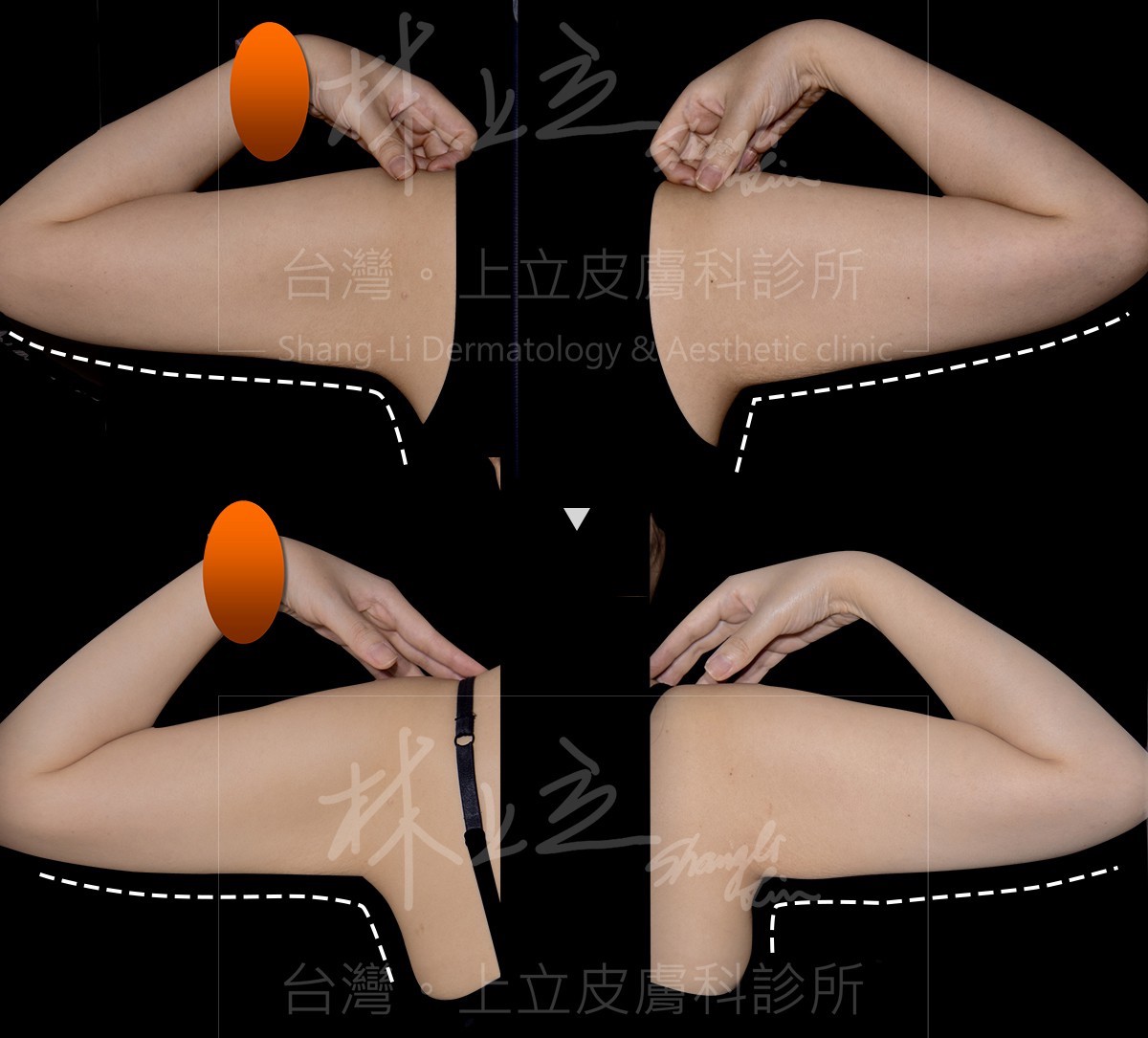 SculpSure絲酷秀（體外雷射溶脂）單次治療的1個月之後，可看見手臂線條更為俐落，且副乳也有所改善。