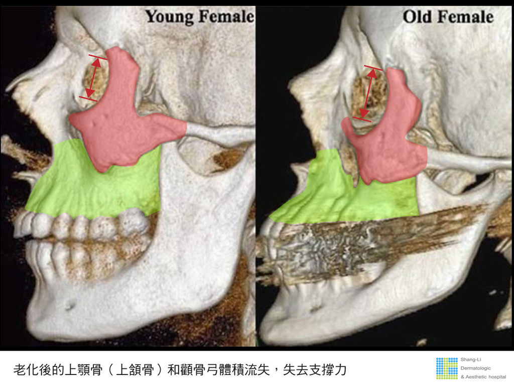 年輕跟老化的年輕跟老化的骨架脂肪比較