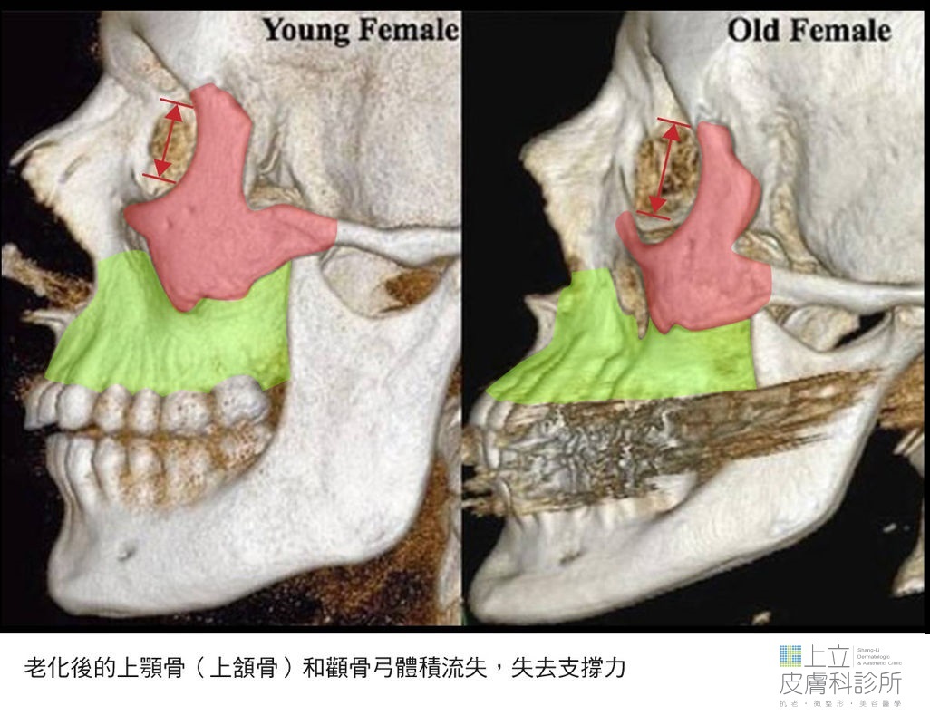年輕女性與年老女性的骨骼肌肉比較