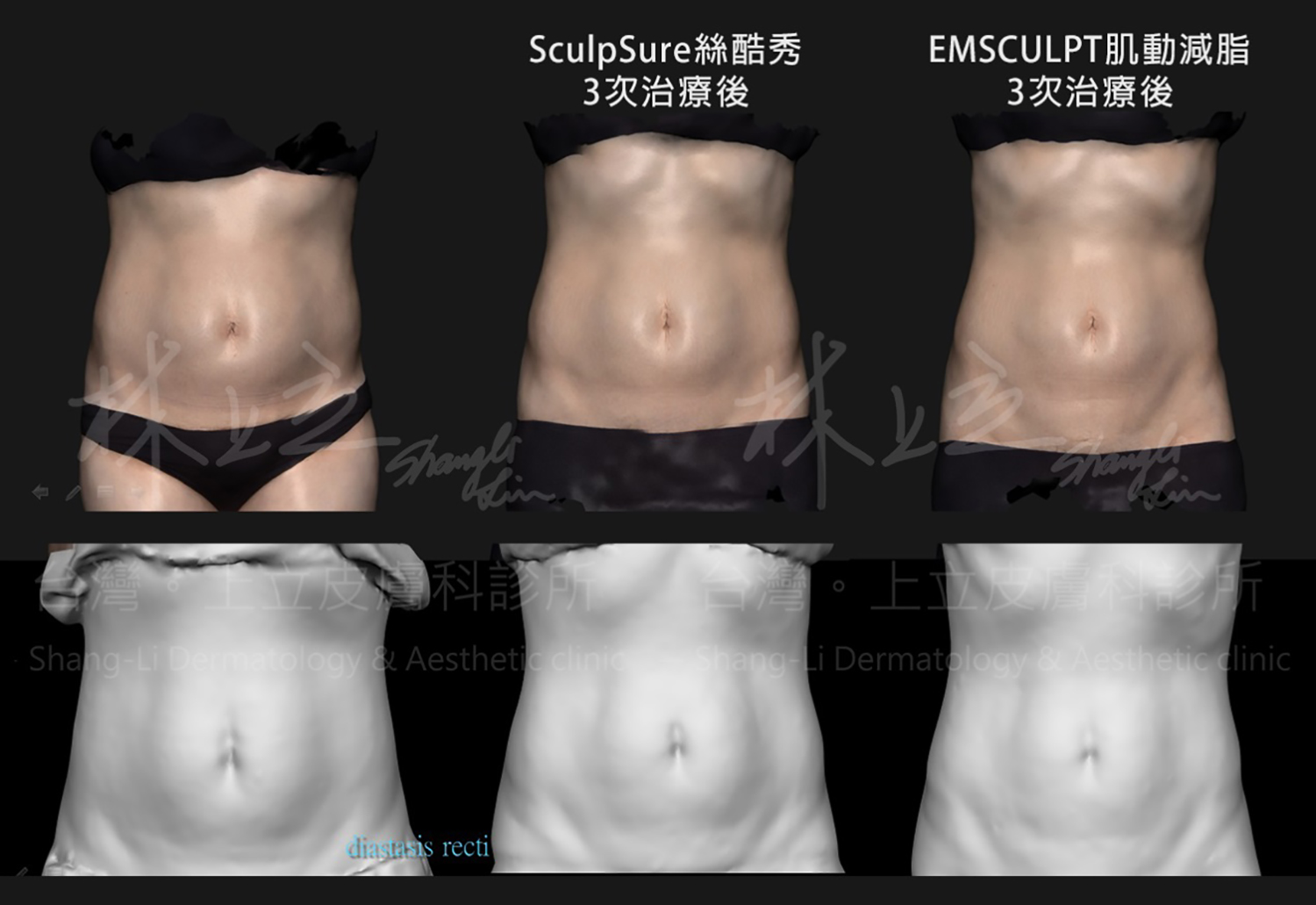 運用EMSCULPT肌動減脂，同時治療肌肉和深層脂肪。