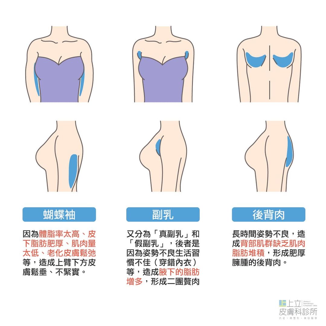 蝴蝶袖、副乳、後背肉都是Scuptra治療的重點部位