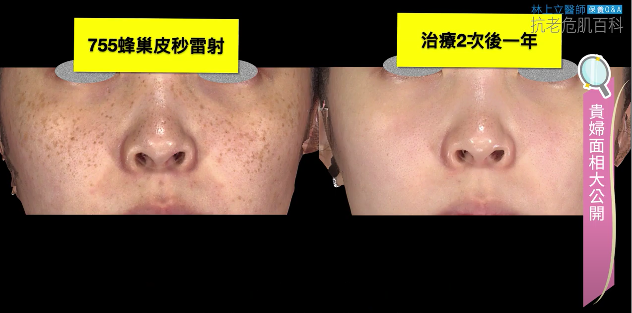 755蜂巢皮秒雷射治療兩次後一年皮膚膚質大幅改善