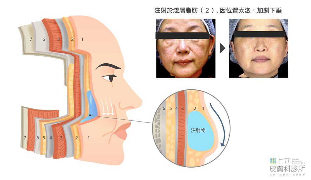 施打位置太淺，術後變澎、變腫，成了大餅臉