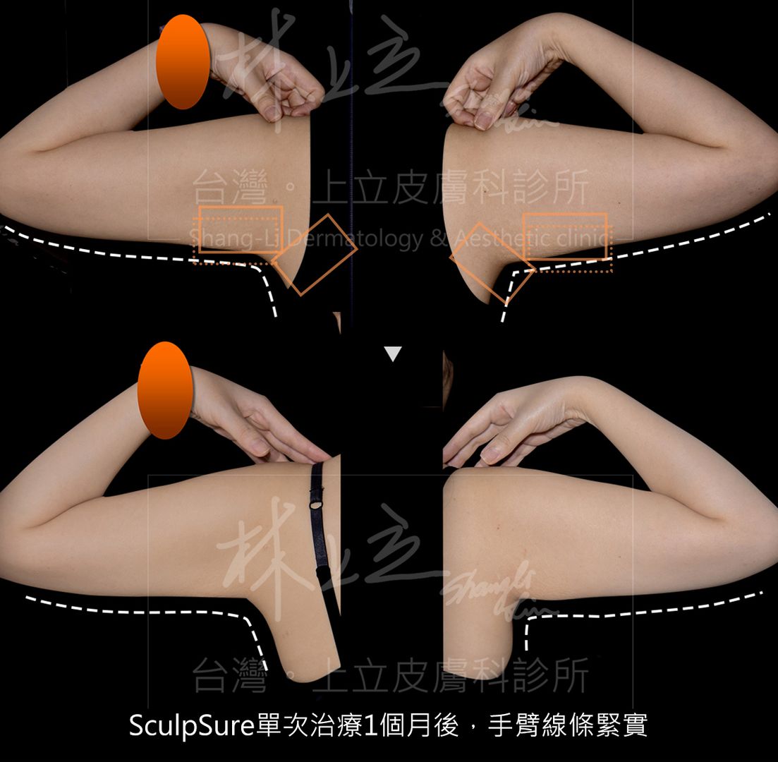 SculpSure 絲酷秀有效減脂蝴蝶袖和收緊肌膚的效果。