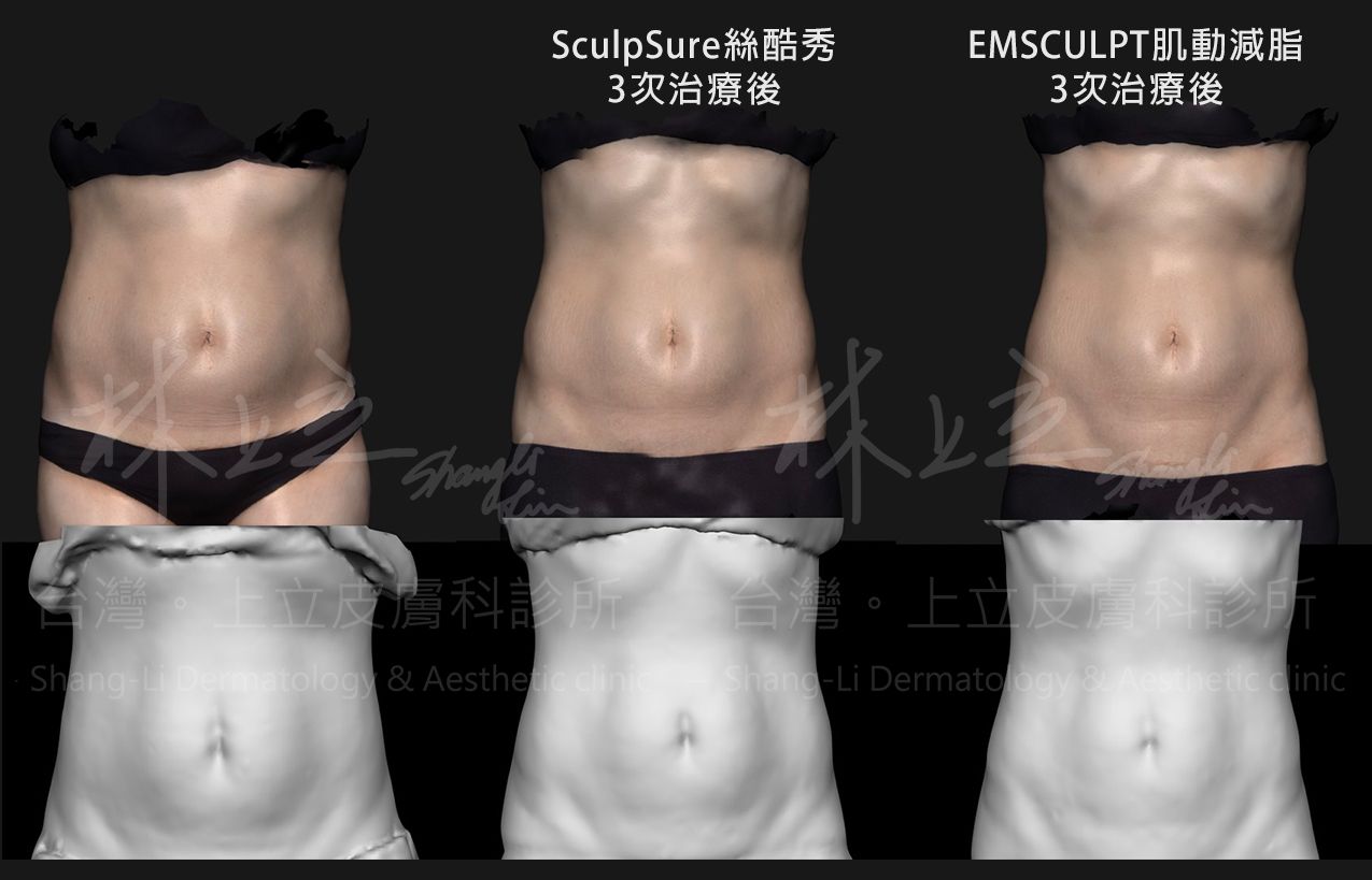 SculpSure絲酷秀與EMSCULPT肌動減脂做結合治療三次後比較