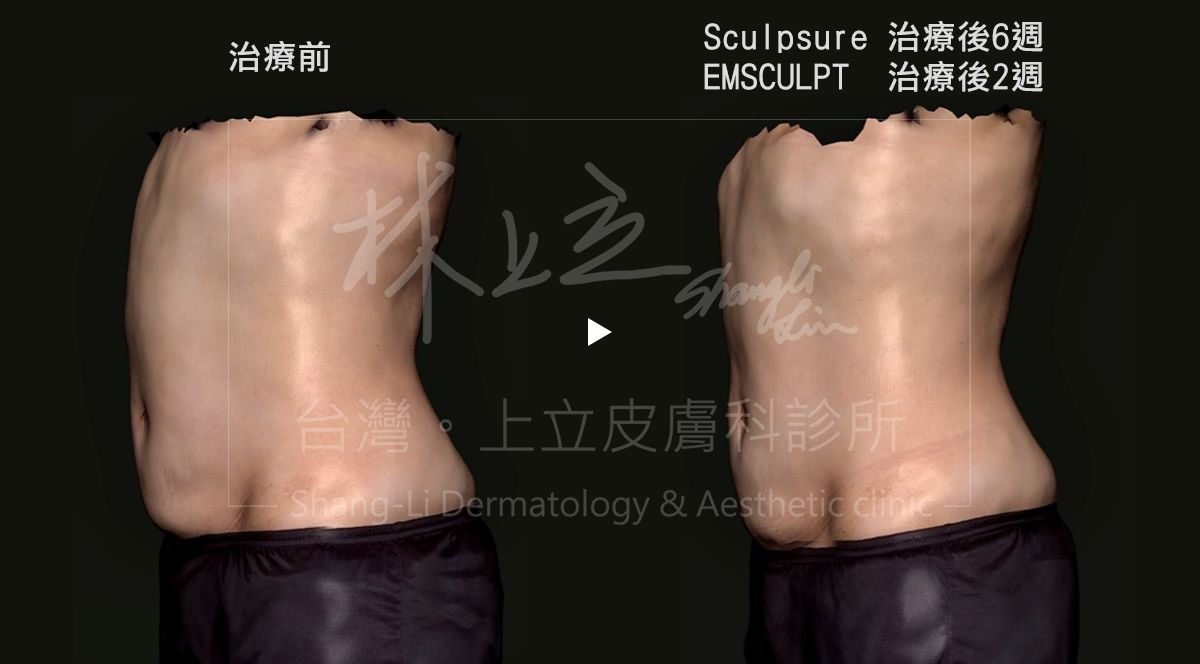 腹部肌肉SculpSure絲酷秀治療後6週與EMSCULPT肌動減脂治療後2週