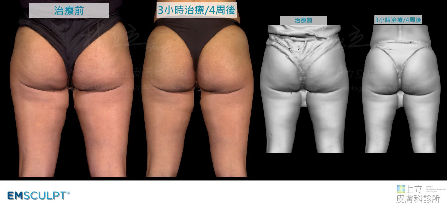 EMSCULPT大腿、臀部經過不同探頭的擺放、療程設計，除了大腿看起來變細