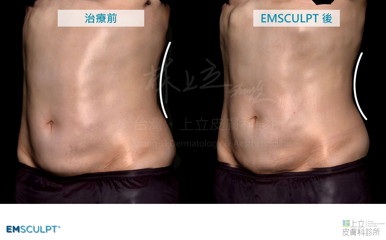 EMSCULPT肌動減脂擺放在正確位置上，在鍛鍊腹部核心肌群的同時，連帶也能雕塑側腹腰線