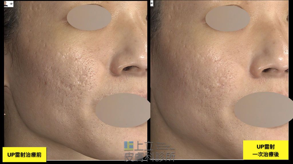 UP 雷射改善痘疤膚質伴隨的毛孔粗大，流失位於更深層 