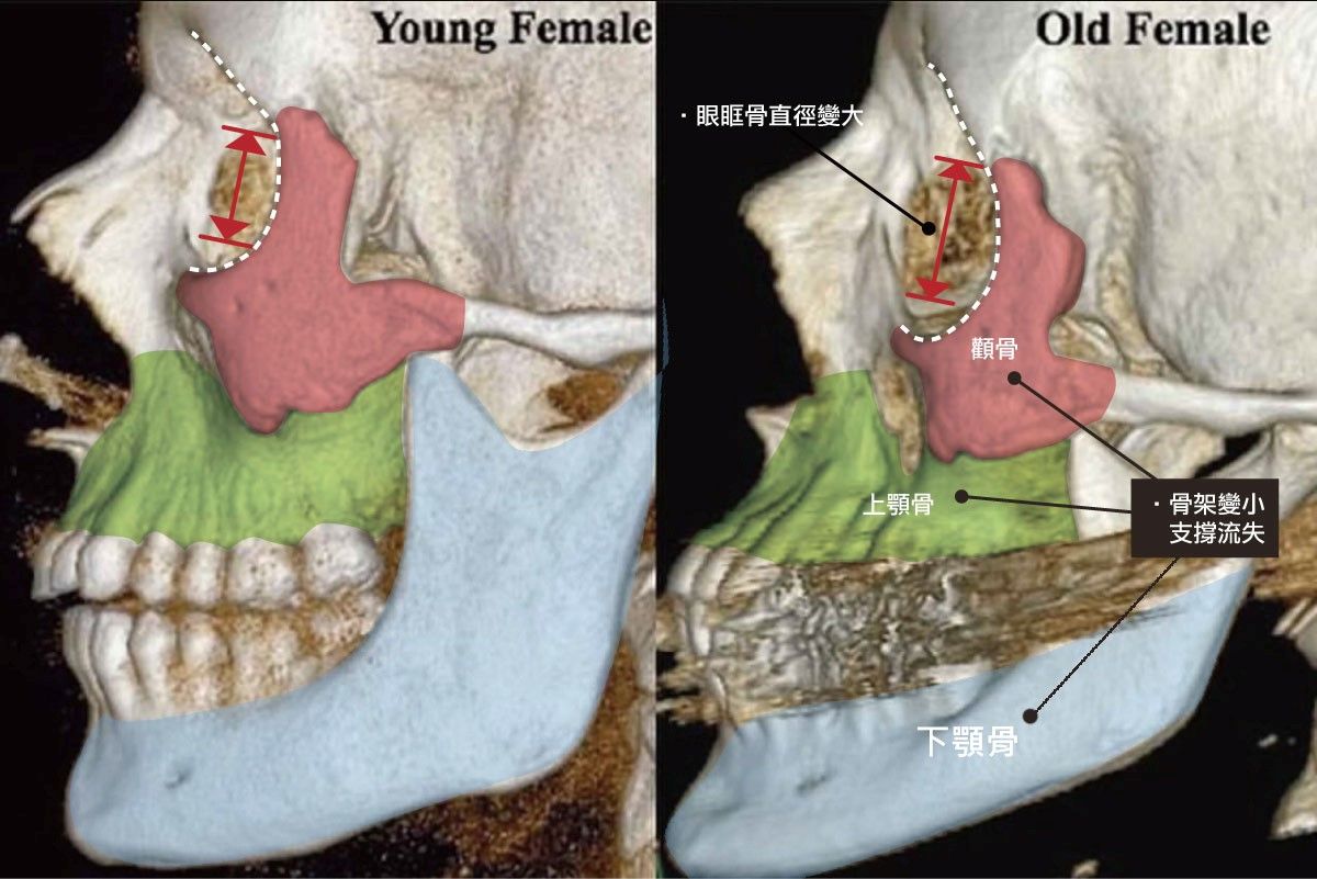 年輕的骨架到老化的骨架，體積明顯減少、退縮，支撐力也會因此變差