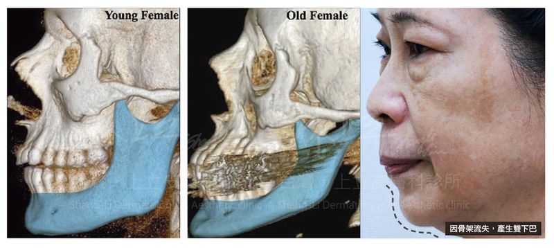 上頷骨跟下頷骨的流失會導致慢慢失去支撐肌肉的功能，在嘴角周圍形成堆積的嘴邊肉
