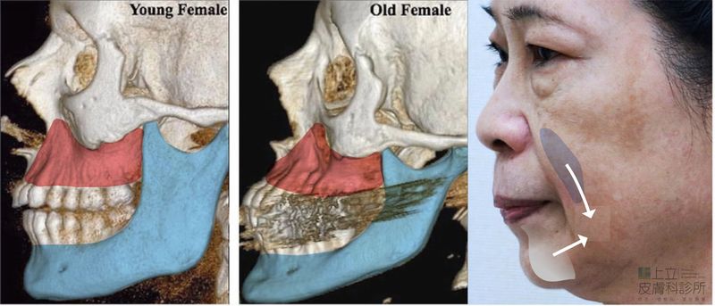 下顎骨流失，讓組織堆積在下半臉，因此形成木偶紋、嘴邊肉