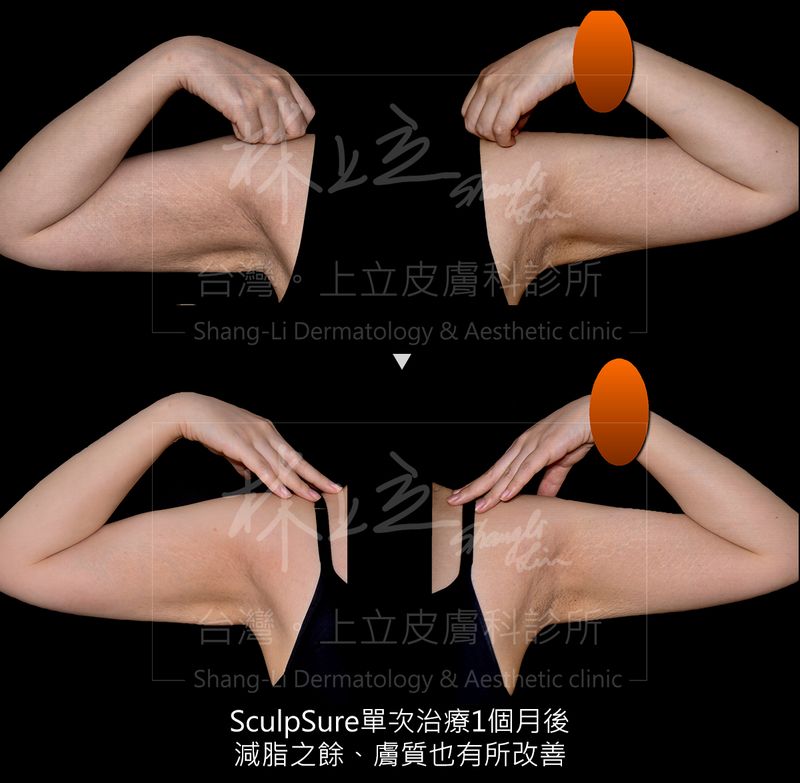 SculpSure絲酷秀治療一個月後，減脂之餘，膚質也有所改善