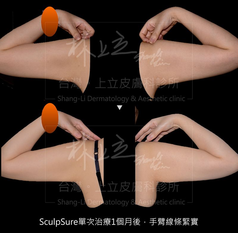 SculpSure絲酷秀體外雷射溶脂單次治療的1個月之後，可看見手臂線條更為俐落。