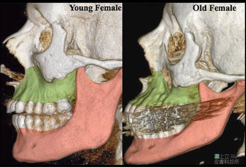 下半臉的骨架會隨著老化逐漸流失變形，雙下巴、嘴邊肉、下顎線模糊等，都是下臉骨架流失。