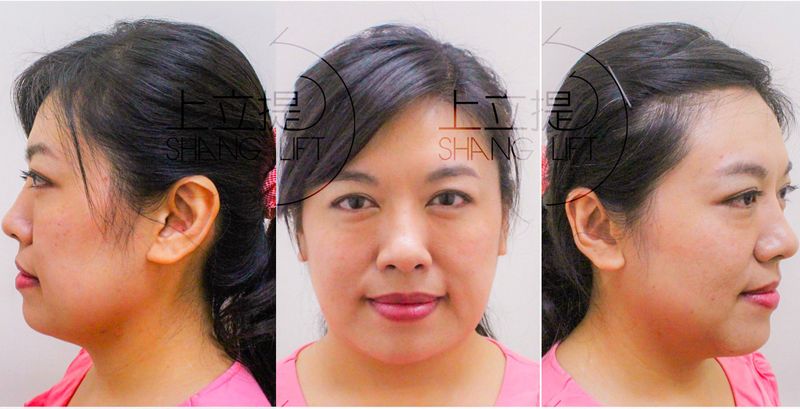 亞洲人皮下脂肪較肥厚，加上老化導致骨架流失，造成脂肪堆積在下半臉，容易有雙下巴