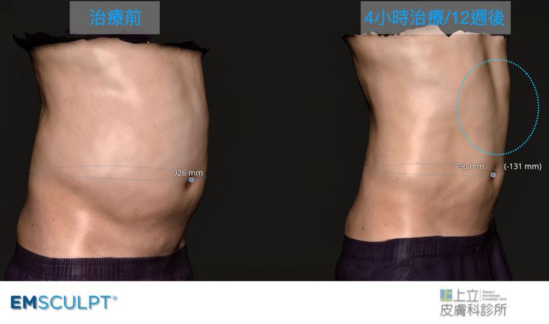 接受4小時EMSCULPT肌動減脂的治療之後，追蹤術後12週治療效果，可見腹部與腰際的線條雕塑都有非常不錯的效果。