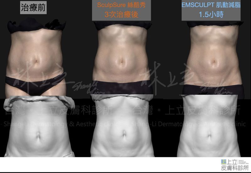 三次SculpSure絲酷秀（體外雷射溶脂）療程，減去了上下腹部的部分脂肪，初步雕塑腰腹線條之後；再利用EMSCULPT肌動減脂去強化腹部肌肉力量，改善腹直肌分離的狀況
