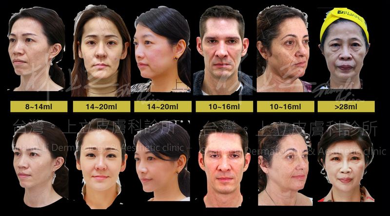 根據每個人臉部流失程度不同，所需要補回來的體積也不一樣