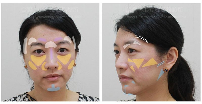 洢蓮絲有效解決全臉老化流失的問題，同步改善木偶紋。