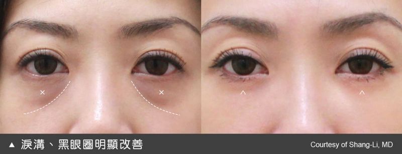淚溝凹陷造成眼下陰影經常會被誤認為黑眼圈，所以當淚溝改善了，黑眼圈也會明顯淡化許多。