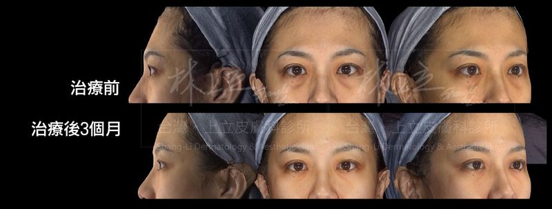 艾麗斯重建眼眶骨的支撐之後，有效改善淚溝凹陷，連同黑眼圈也因而淡化許多