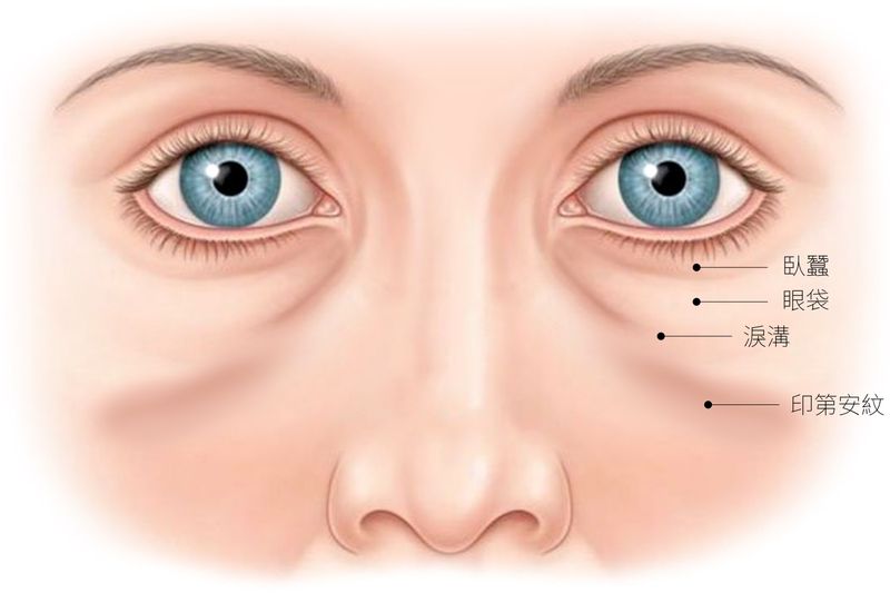 淚溝、眼袋、印第安紋都是眼周常見問題，一樣都和眼周支撐流失有關係